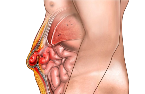Hernia Surgery Cost in Dubai