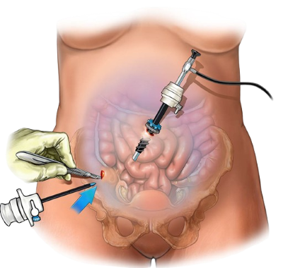 laparoscopic-surgery