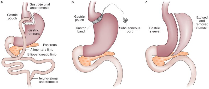 Weight Loss with Restrictive Bariatric Surgery