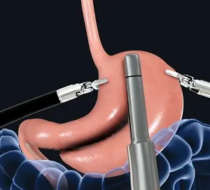 Sustainable Weight Loss Through Expert Gastric Sleeve Surgery