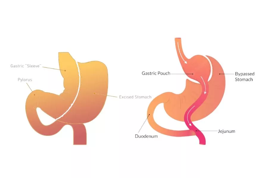 Weight Loss: Gastric Sleeve vs Bypass Surgery