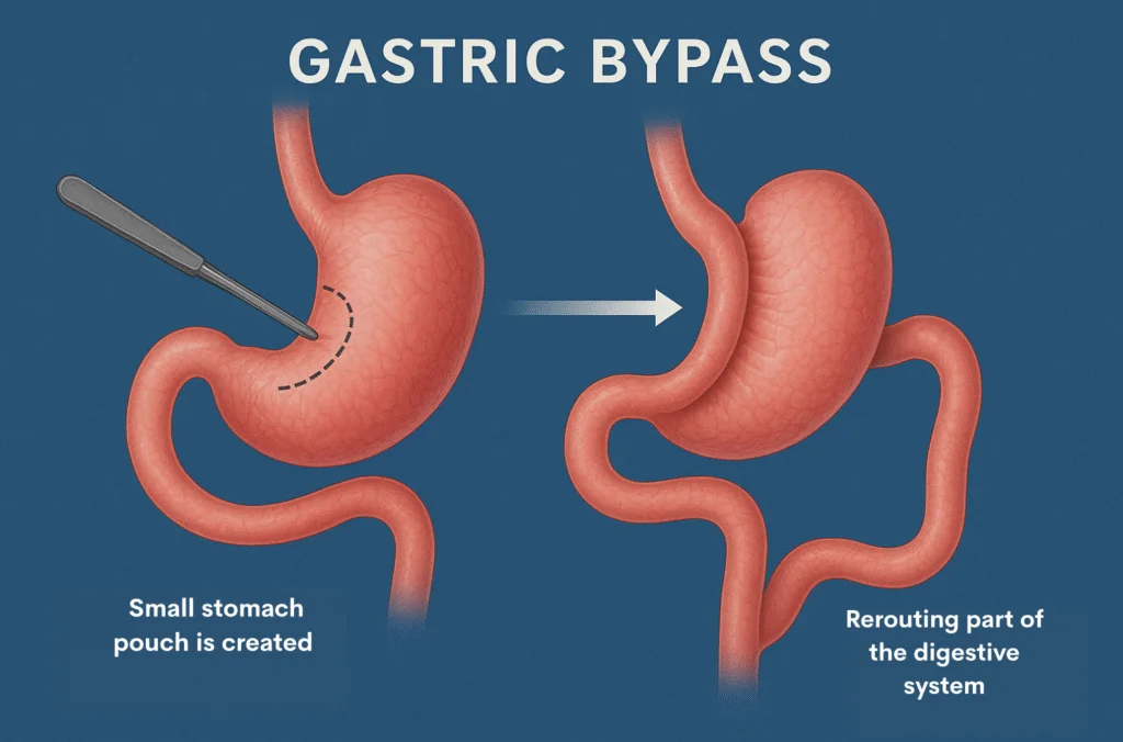 Gastric Sleeve and Bypass: The Ultimate Weight Loss Guide