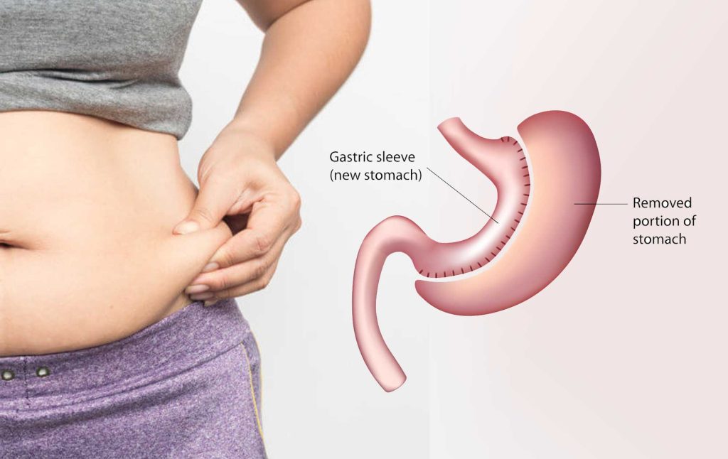 Exploring Weight Loss Solutions: Is Gastric Sleeve or Bypass Right for You?