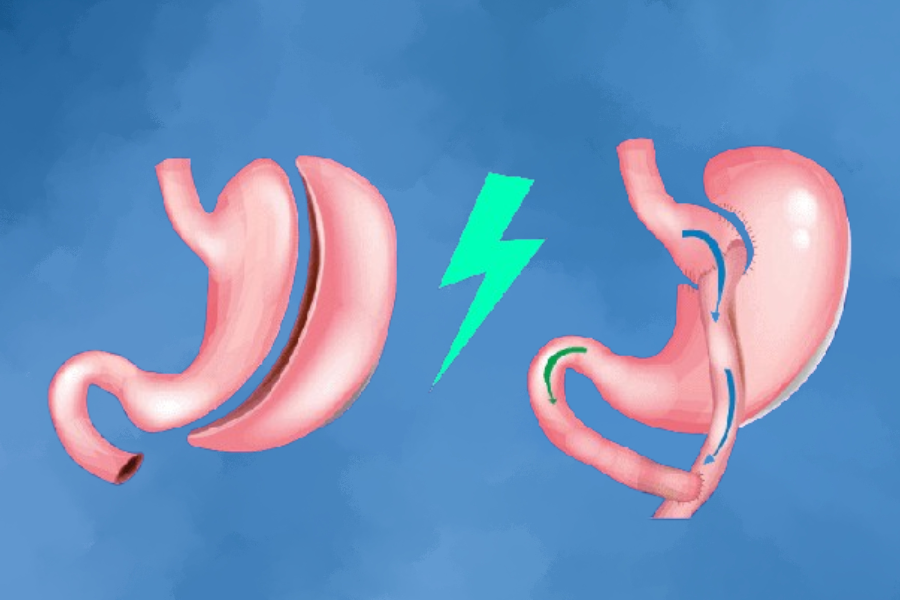 Gastric Sleeve vs Bypass: Real Results for Weight Loss