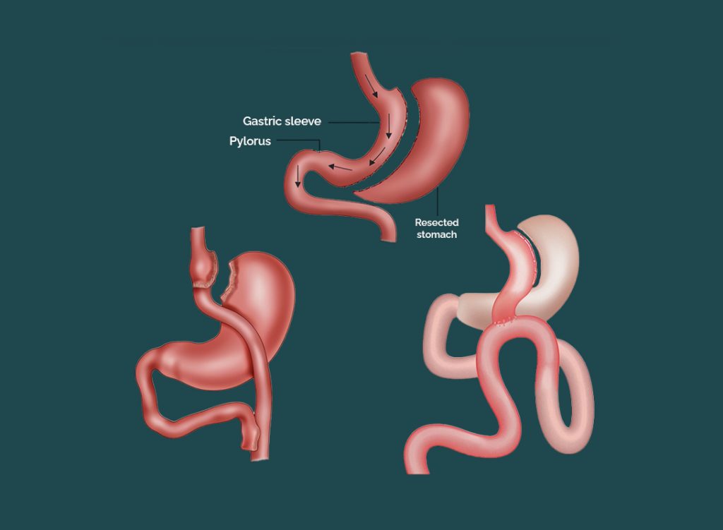 A Smarter Path to Weight Loss: Choosing Gastric Sleeve or Bypass