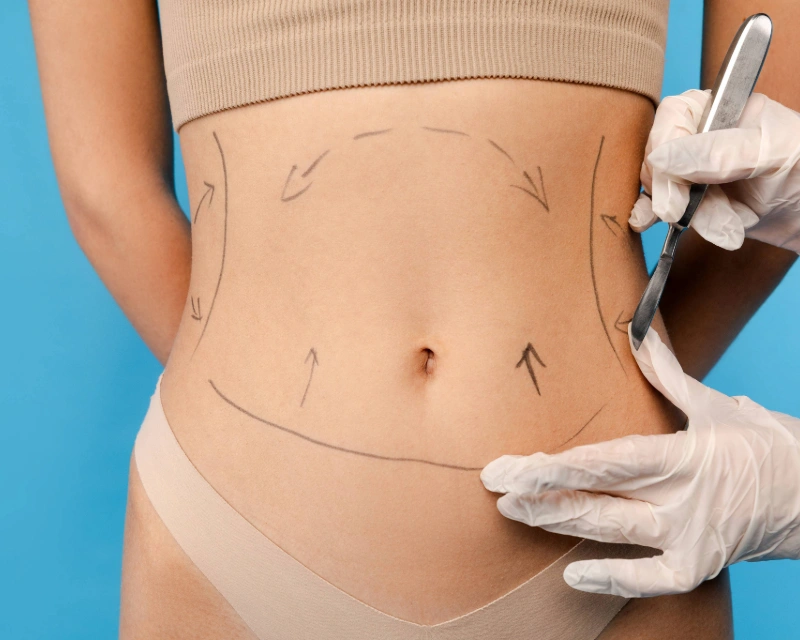 Gastric Sleeve Surgery