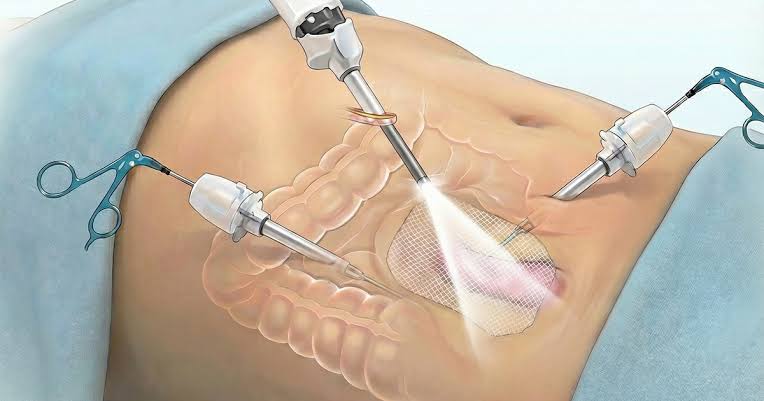 Why Choosing an Experienced Laparoscopic Surgeon Matters